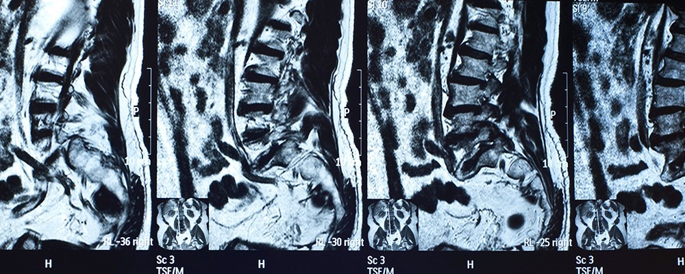 Slider-MRI-Spine-02